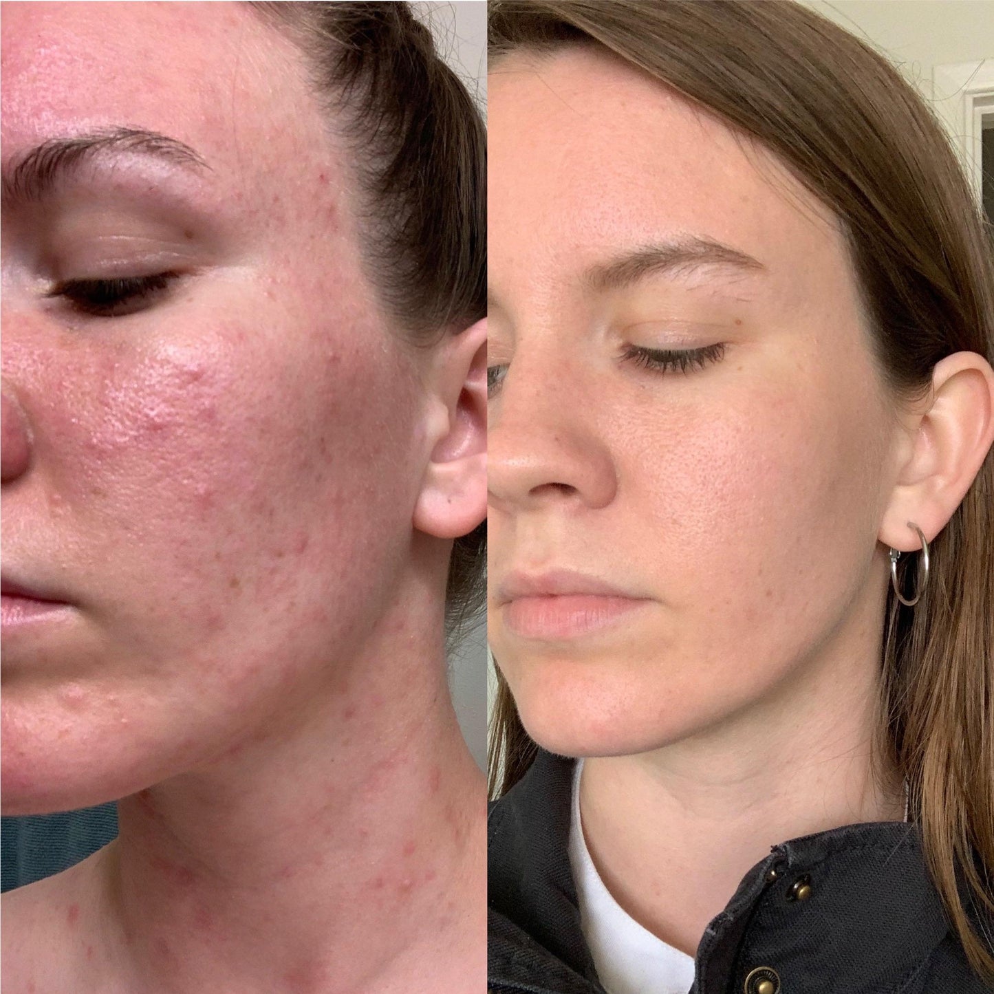 DermaSkins Eczema Treatment