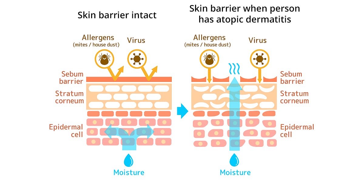 DermaSkins Full Eczema Treatment + FREE Eczema Treatment