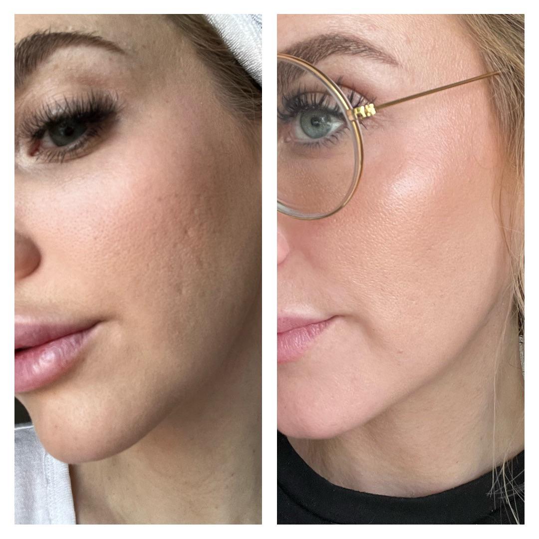 DermaSkins Scar Removal Gel
