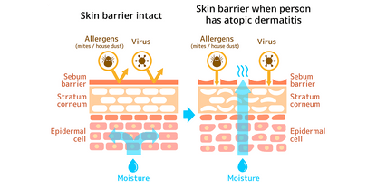 DermaSkins Full Eczema Treatment + FREE Eczema Treatment